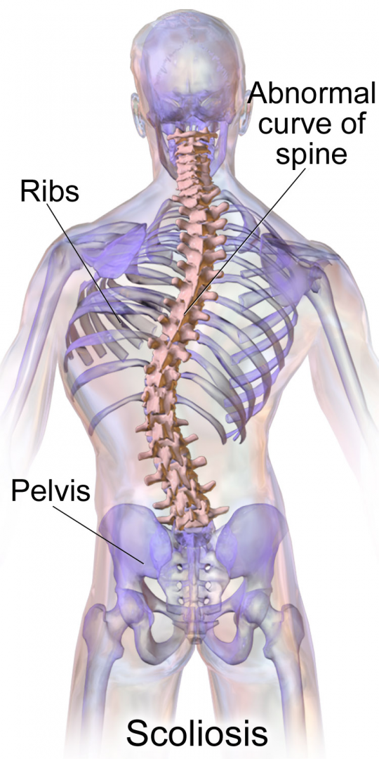 Scoliosis spine curvature x-ray